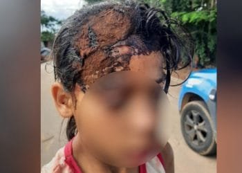 Anápolis: Criança leva pedrada na cabeça durante briga por chocolate