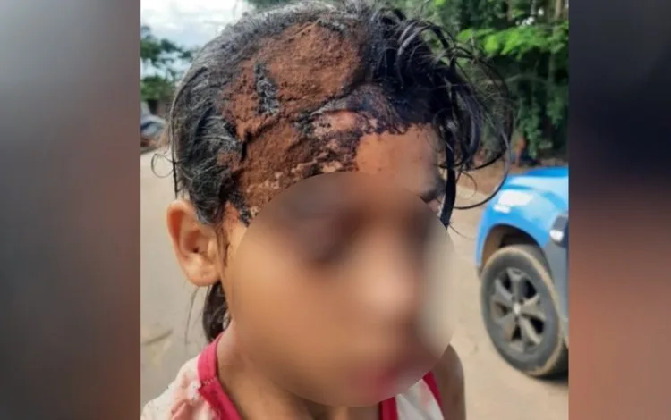 Anápolis: Criança leva pedrada na cabeça durante briga por chocolate