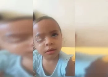 Criança gruda olho com Super Bonder e precisa de cirurgia