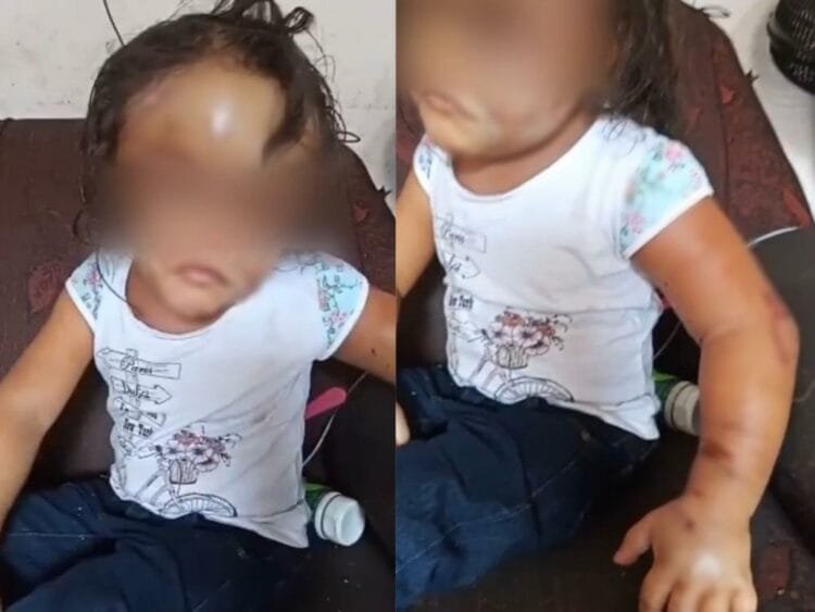 Polícia Civil prende responsáveis por desfigurar rosto de criança de 4 anos