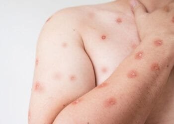 Goiás tem cinco casos de Mpox em investigação; Secretaria Municipal de Saúde reforça cuidados à população