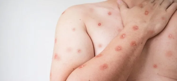 Goiás tem cinco casos de Mpox em investigação; Secretaria Municipal de Saúde reforça cuidados à população