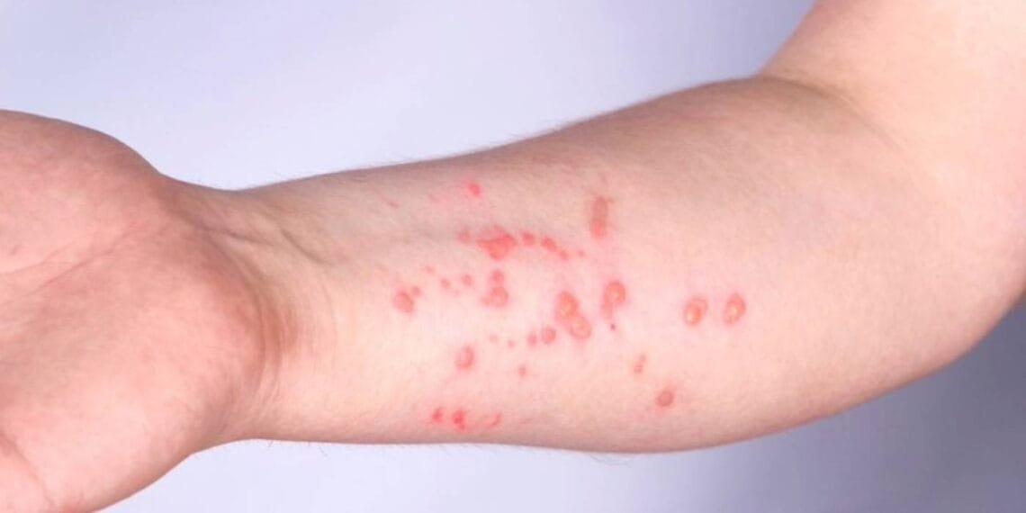 Mpox: Brasil registra 140 casos em 2026; saiba os estados com mais ocorrências.