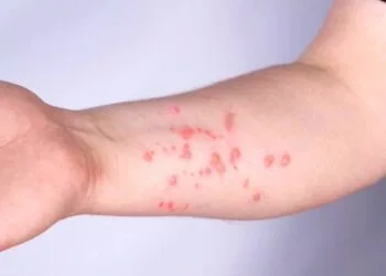 Mpox: Brasil registra 140 casos em 2026; saiba os estados com mais ocorrências.