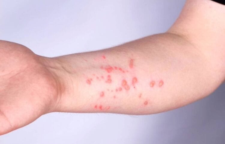 Mpox: Brasil registra 140 casos em 2026; saiba os estados com mais ocorrências.