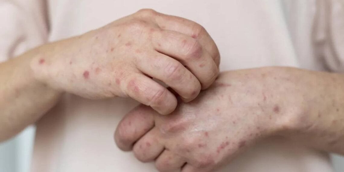 Sarampo: RJ confirma primeiro caso da doença em 2026