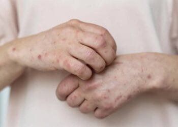 Sarampo: RJ confirma primeiro caso da doença em 2026